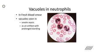 Vacuoles in neutrophils
• In Fresh blood smear
• vacuoles seen in
– severe sepsis
– as an artifact with
prolonged standing
 