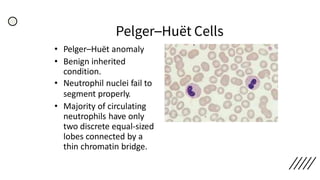 Pelger–Huët Cells
• Pelger–Huët anomaly
• Benign inherited
condition.
• Neutrophil nuclei fail to
segment properly.
• Majority of circulating
neutrophils have only
two discrete equal-sized
lobes connected by a
thin chromatin bridge.
 