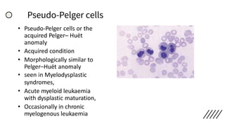 Pseudo-Pelger cells
• Pseudo-Pelger cells or the
acquired Pelger– Huët
anomaly
• Acquired condition
• Morphologically similar to
Pelger–Huët anomaly
• seen in Myelodysplastic
syndromes,
• Acute myeloid leukaemia
with dysplastic maturation,
• Occasionally in chronic
myelogenous leukaemia
 