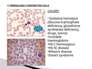glutathione synthetase deficiency smear Comprehensive Guide to Peripheral Blood Preparation and Examination Size:100 CT Adaptive epigenetic response of nootropics_and_neurotrophics