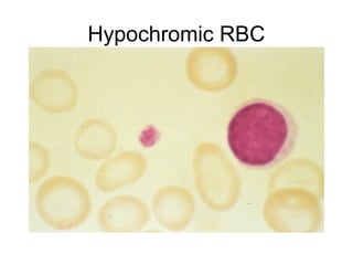 Hypochromic RBC
 