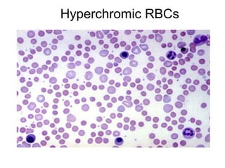 Hyperchromic RBCs
 