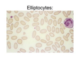 Elliptocytes:
 