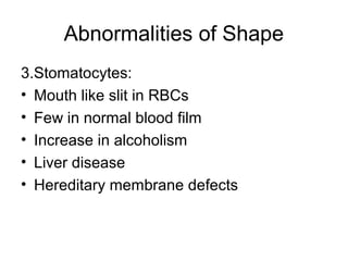 Abnormalities of Shape
3.Stomatocytes:
• Mouth like slit in RBCs
• Few in normal blood film
• Increase in alcoholism
• Liver disease
• Hereditary membrane defects
 