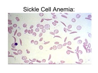 Sickle Cell Anemia:
 