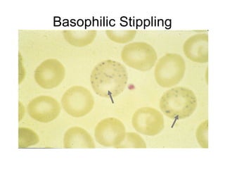 Basophilic Stippling
 