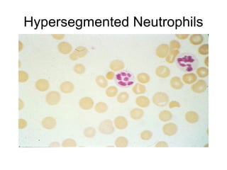 Hypersegmented Neutrophils
 