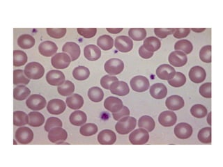 Peripheral smear 