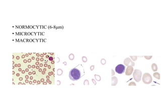 • NORMOCYTIC (6-8μm)
• MICROCYTIC
• MACROCYTIC
 