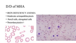 D/D of MHA
• IRON DEFICIENCY ANEMIA
• Moderate anisopoikilocytosis
• Pencil cells, elongated cells
• Thrombocytosis+/-
 