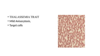 • THALASSEMIA TRAIT
• Mild Anisocytosis,
• Target cells
 