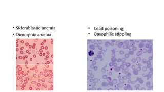 • Sideroblastic anemia
• Dimorphic anemia
• Lead poisoning
• Basophilic stippling
 