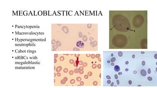 MEGALOBLASTIC ANEMIA
• Pancytopenia
• Macrovalocytes
• Hypersegmented
neutrophils
• Cabot rings
• nRBCs with
megaloblastic
maturation
 