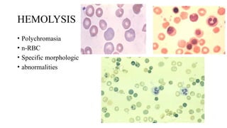 HEMOLYSIS
• Polychromasia
• n-RBC
• Specific morphologic
• abnormalities
 