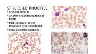 SPHERO-ECHINOCYTES
• Crenated spheres
• Artefact-Prolonged standing of
blood
• Post transfusion smear
transfused with stored blood
• Sodium chlorate poisoning
 