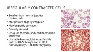 IRREGULARLY CONTRACTED CELLS
• Smaller than normal (appear
contracted)
• Margins are slightly irregular
• May be partly concave
• Densely stained
• Drug- or chemical-induced haemolytic
anaemias
• Unstable haemoglobinopathies Hb
Koln or Hb St Mary’s and in Hb E
homozygosity , HbE heterozygosity
 