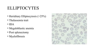 ELLIPTOCYTES
• Heriditary Elliptocytosis (>25%)
• Thalassemia trait
• IDA
• Megaloblastic anemia
• Post splenectomy
• Myelofibrosis
 