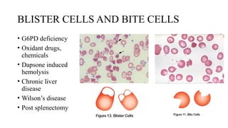 BLISTER CELLS AND BITE CELLS
• G6PD deficiency
• Oxidant drugs,
chemicals
• Dapsone induced
hemolysis
• Chronic liver
disease
• Wilson’s disease
• Post splenectomy
 