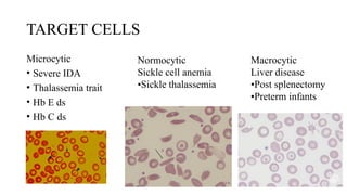 TARGET CELLS
Microcytic
• Severe IDA
• Thalassemia trait
• Hb E ds
• Hb C ds
Normocytic
Sickle cell anemia
•Sickle thalassemia
Macrocytic
Liver disease
•Post splenectomy
•Preterm infants
 