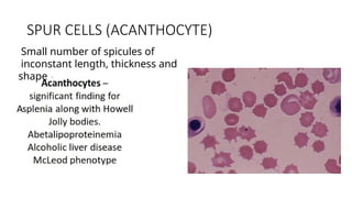 SPUR CELLS (ACANTHOCYTE)
Small number of spicules of
inconstant length, thickness and
shape
 