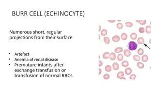 BURR CELL (ECHINOCYTE)
• Artefact
• Anemia of renal disease
• Premature infants after
exchange transfusion or
transfusion of normal RBCs
Numerous short, regular
projections from their surface
 