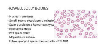 HOWELL JOLLY BODIES
• Nuclear remnants
• Small, round cytoplasmic inclusions
• Stain purple on a Romanowsky stain
• Hyposplenic states
• Post splenectomy
• Megaloblastic anemia
• Follow up of post splenectomy refractory ITP/ AIHA
 