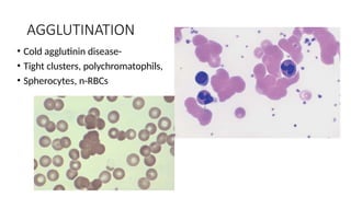 AGGLUTINATION
• Cold agglutinin disease-
• Tight clusters, polychromatophils,
• Spherocytes, n-RBCs
 