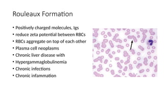 Rouleaux Formation
• Positively charged molecules, Igs
• reduce zeta potential between RBCs
• RBCs aggregate on top of each other
• Plasma cell neoplasms
• Chronic liver disease with
• Hypergammaglobulinemia
• Chronic infections
• Chronic infammation
 