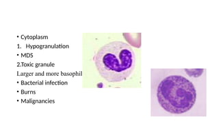 • Cytoplasm
1. Hypogranulation
• MDS
2.Toxic granule
Larger and more basophilic
• Bacterial infection
• Burns
• Malignancies
 