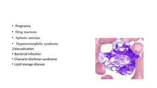 • Pregnancy
• Drug reactions
• Aplastic anemias
• Hypereosinophilic syndrome
3.Vacuolisation
• Bacterial infection
• Chanarin-Dorfman syndrome
• Lipid storage disease
 