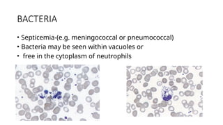 BACTERIA
• Septicemia-(e.g. meningococcal or pneumococcal)
• Bacteria may be seen within vacuoles or
• free in the cytoplasm of neutrophils
 