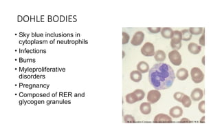 DOHLE BODIES
• Sky blue inclusions in
cytoplasm of neutrophils
• Infections
• Burns
• Myleproliferative
disorders
• Pregnancy
• Composed of RER and
glycogen granules
 