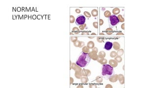 NORMAL
LYMPHOCYTE
 