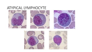 ATYPICAL LYMPHOCYTE
 