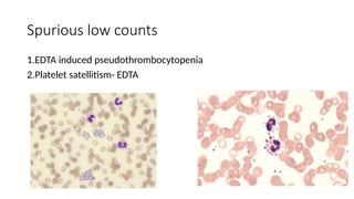 Spurious low counts
1.EDTA induced pseudothrombocytopenia
2.Platelet satellitism- EDTA
 
