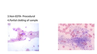 3.Non-EDTA- Procedural
4.Partial clotting of sample
 