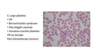 5. Large platelets
• ITP
• Bernard Soulier syndrome
• May Hegglin anomaly
• Immature reactive platelets-
ITP on steroids
Post chemotherapy recovery
 