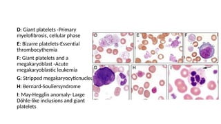 D: Giant platelets -Primary
myelofibrosis, cellular phase
E: Bizarre platelets-Essential
thrombocythemia
F: Giant platelets and a
megakaryoblast -Acute
megakaryoblastic leukemia
G: Stripped megakaryocyticnucleus.
H: Bernard-Souliersyndrome
I: May-Hegglin anomaly- Large
Döhle-like inclusions and giant
platelets
 