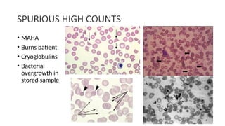 SPURIOUS HIGH COUNTS
• MAHA
• Burns patient
• Cryoglobulins
• Bacterial
overgrowth in
stored sample
 