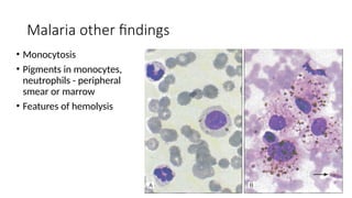 Malaria other findings
• Monocytosis
• Pigments in monocytes,
neutrophils - peripheral
smear or marrow
• Features of hemolysis
 