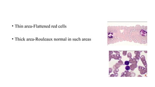 • Thin area-Flattened red cells
• Thick area-Rouleaux normal in such areas
 