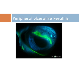 Peripheral ulcerative keratitis
 