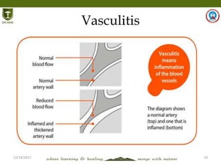 12/14/2017 10
Vasculitis
 