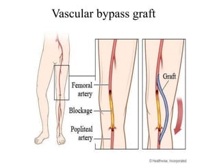 Vascular bypass graft
 
