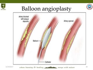 12/14/2017 28
Balloon angioplasty
 