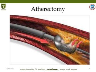 12/14/2017 29
Atherectomy
 