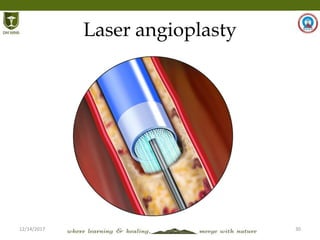 12/14/2017 30
Laser angioplasty
 