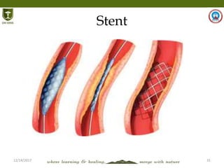 12/14/2017 31
Stent
 