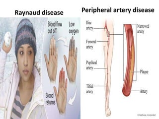 Raynaud disease Peripheral artery disease
 