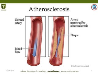 12/14/2017 7
Atherosclerosis
 